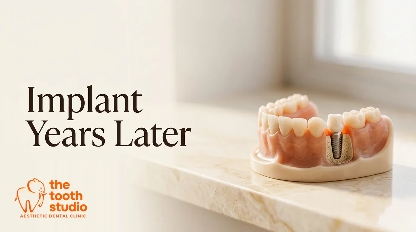 Can You Get an Implant Years After Losing a Tooth? - The Tooth Studio, Kukatpally Hyderabad