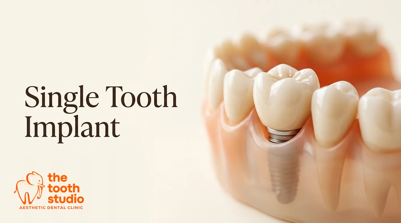 Single Tooth Implant: The Complete Guide - The Tooth Studio, Kukatpally Hyderabad